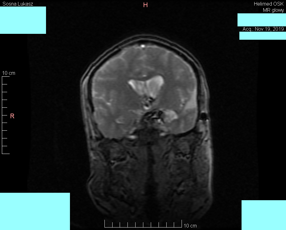 Head MRI result - Luke Sosna - year 2019 - image 2