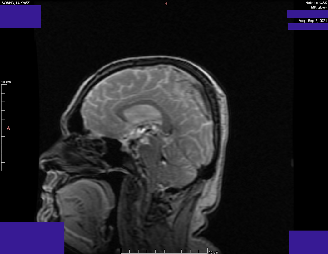 Head MRI result - Luke Sosna - year 2021 - image 2