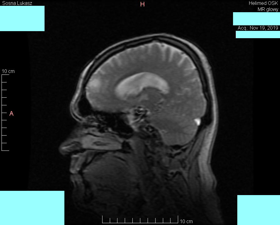 Head MRI result - Luke Sosna - year 2019 - image 3