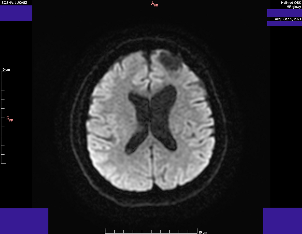 Head MRI result - Luke Sosna - year 2021 - image 3