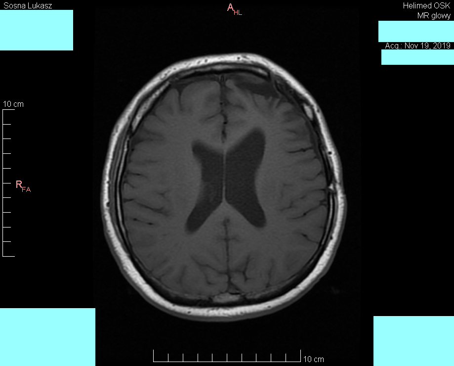 Head MRI result - Luke Sosna - year 2019 - image 4
