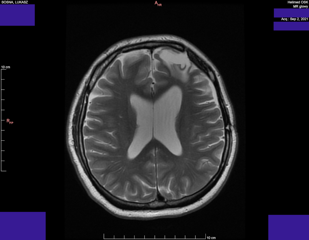 Head MRI result - Luke Sosna - year 2021 - image 4
