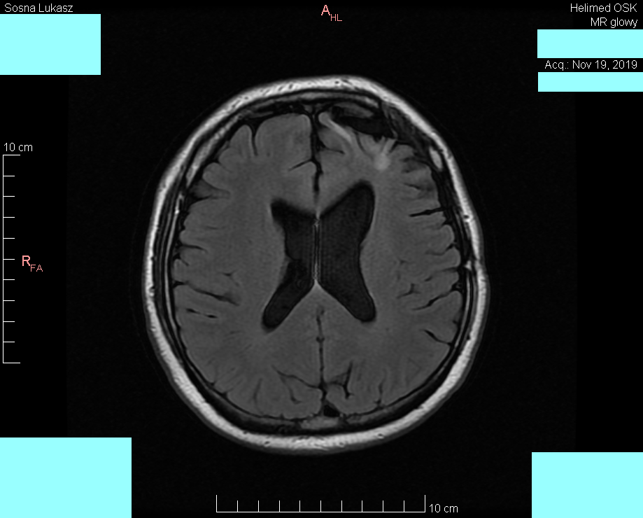 Head MRI result - Luke Sosna - year 2019 - image 5