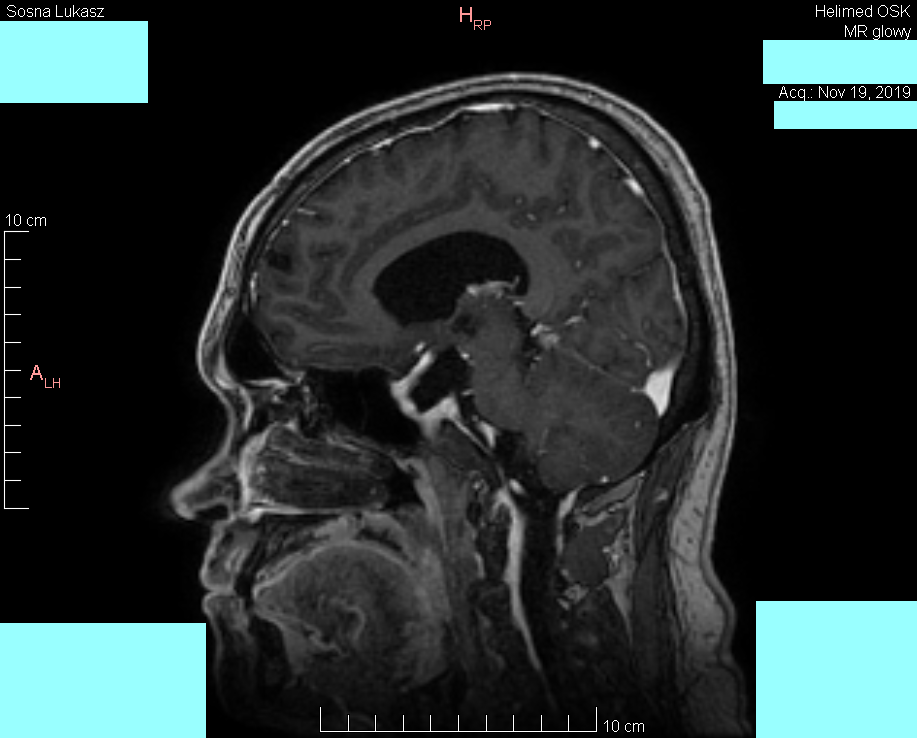 Head MRI result - Luke Sosna - year 2019 - image 8