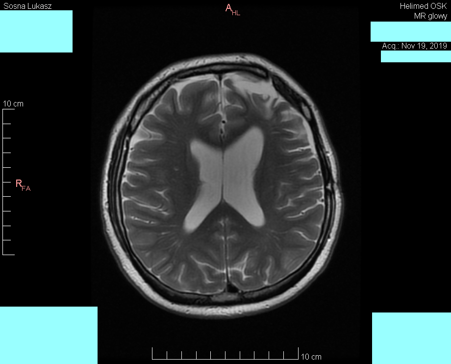Head MRI result - Luke Sosna - year 2019 - image 1