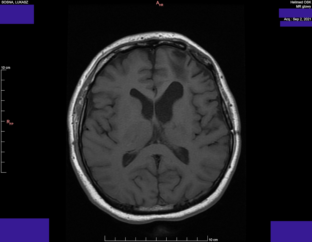 Head MRI result - Luke Sosna - year 2021 - image 5
