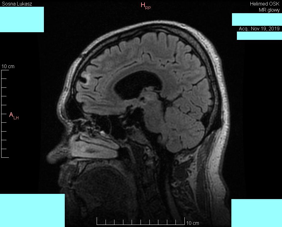 Head MRI result - Luke Sosna - year 2019 - image 6