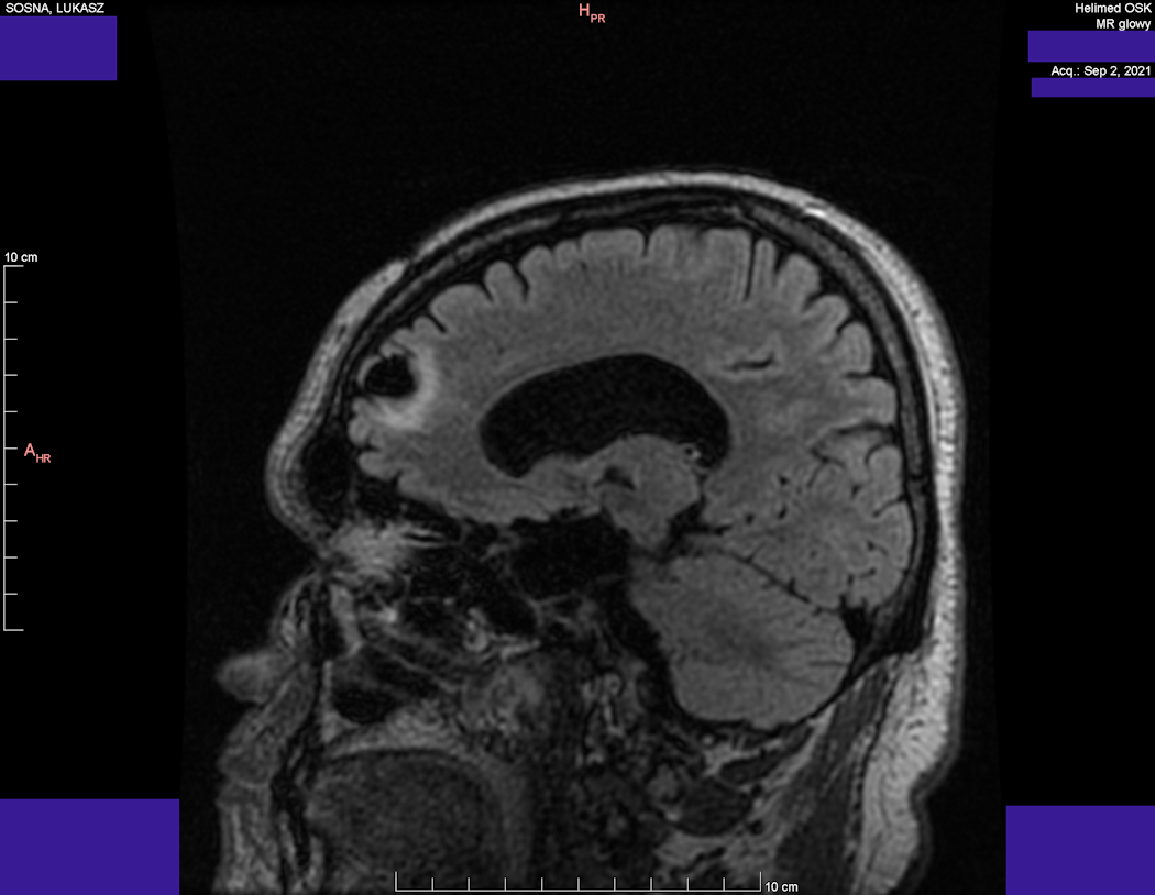 Head MRI result - Luke Sosna - year 2021 - image 6
