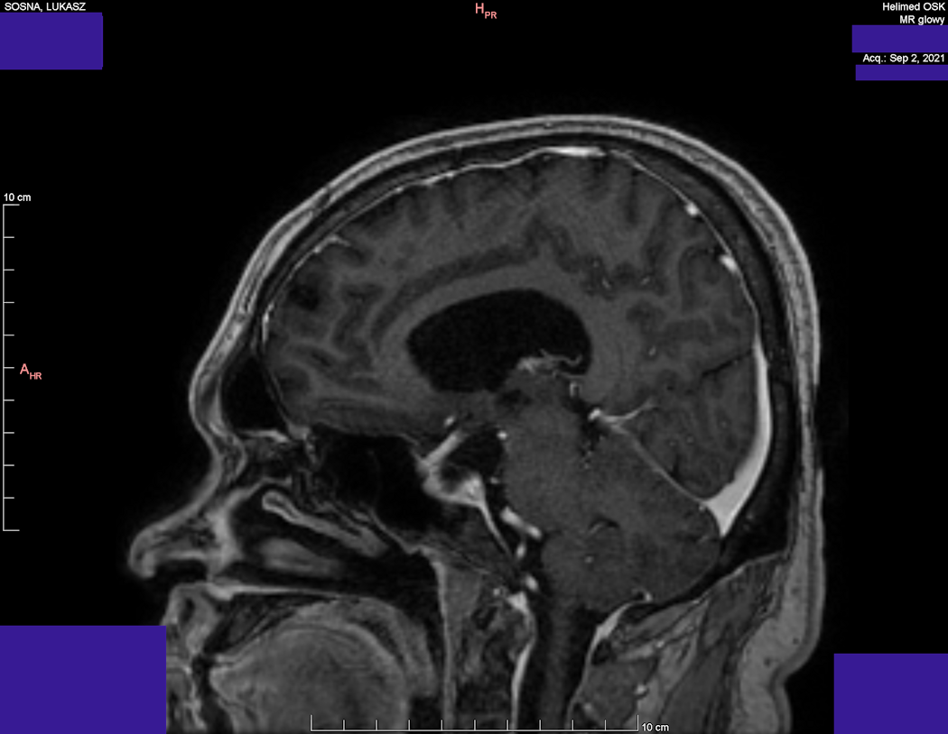 Head MRI result - Luke Sosna - year 2021 - image 7